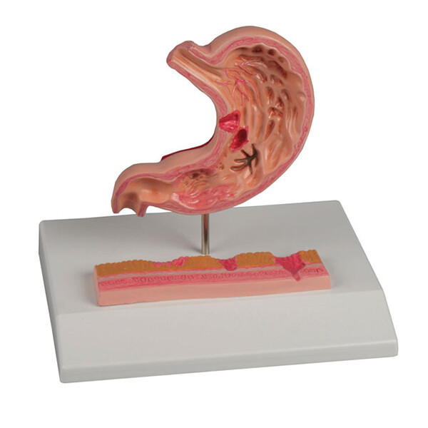 ERLER ZIMMER K217 - 위궤양모형