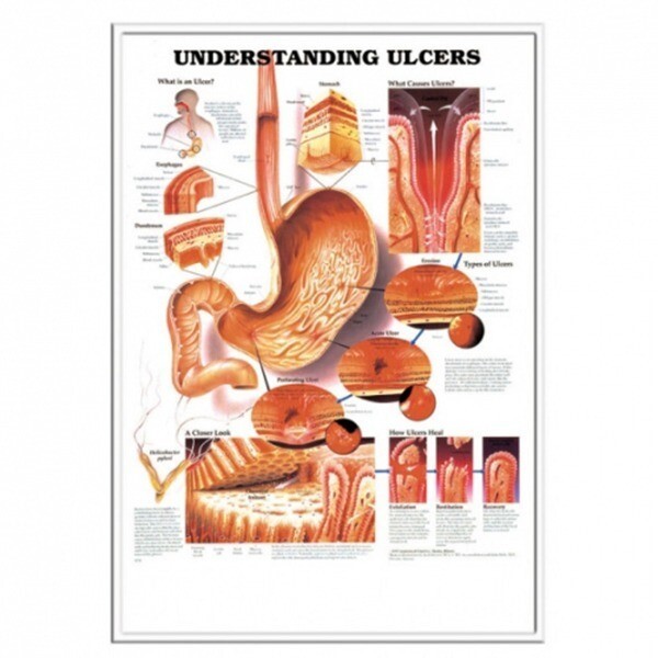 Anatomical  위궤양의이해차트 9731 L사이즈