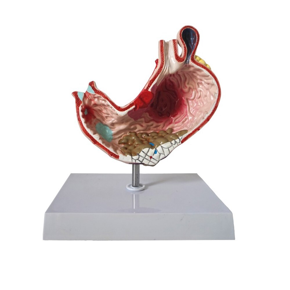 해부학 인체 위 해부학 병리 위궤양 병적 모델