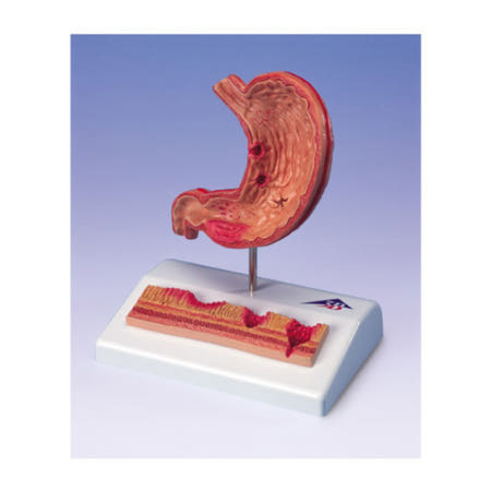 [3B]위궤양모형(K17)