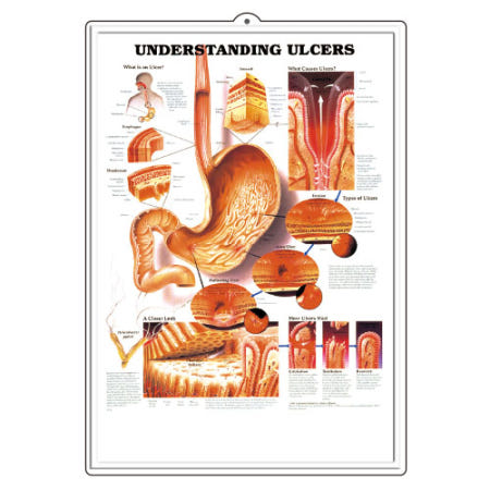 위궤양 인체해부도(3D입체)-9731(Understanding Ulcers)