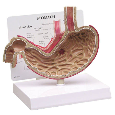 GPI USA 위 해부모형 G200 위궤양모형 위병변 Stomach With Ulcers
